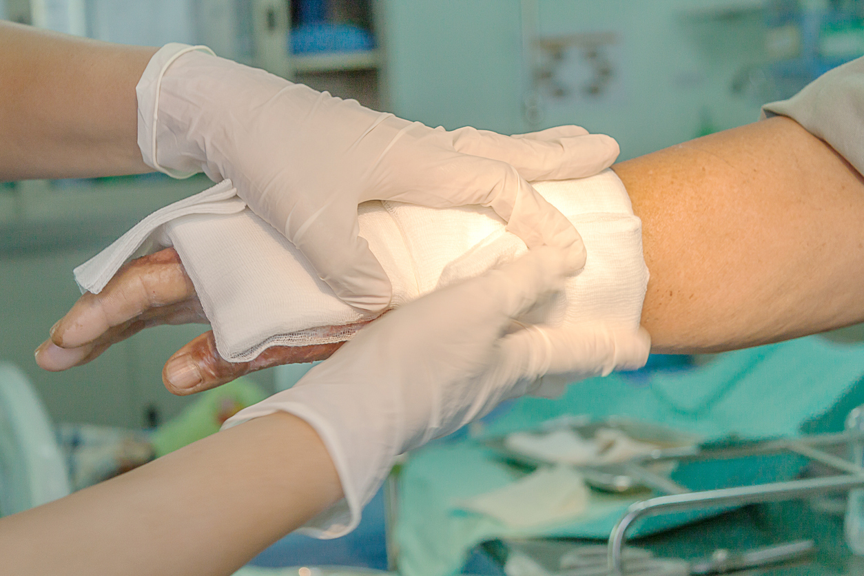 The Lasting Damage of a Severe Burn Injury