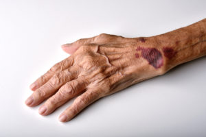 How Our Atlanta Personal Injury Lawyers Can Help You With a Nursing Home Abuse Claim 
