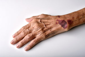 How Our Atlanta Personal Injury Lawyers Can Help You With a Nursing Home Abuse Claim